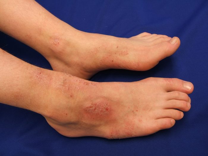 Psoriasis scales sebaceous seborrheic recurrent red hereditary variants conditions related skin silvery clinicaladvisor glands overactive