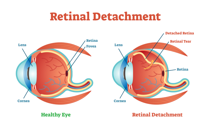 In retinal detachment vitreous humor seeps behind the