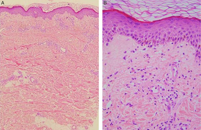 Chronic recurrent dermatosis with silvery gray scales