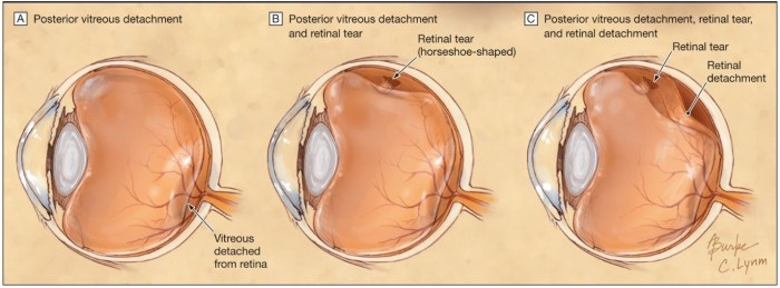 In retinal detachment vitreous humor seeps behind the